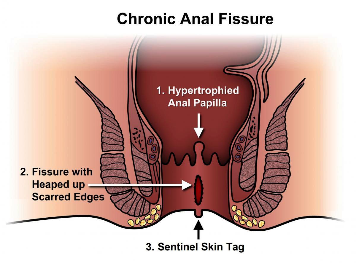 fissure