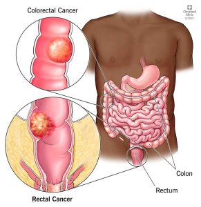 21733-rectal-cancer-illustration